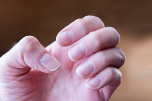 Nail Infection