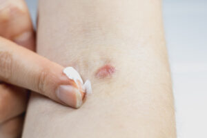 urgent care for a skin abscess or boil