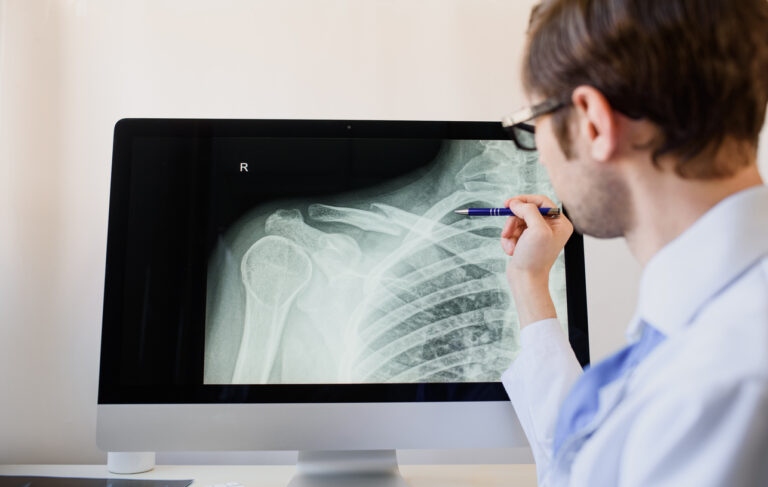 A radiologist analyzes an X-ray image of a clavicle fracture for the urgent-care-for-a-broken-collarbone blog.