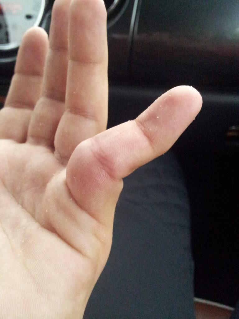 A photo of a dislocated finger after a sports-related accident for urgent-care-for-a-dislocated-finger blog.